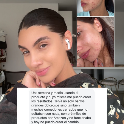 Serum Anti acné y Anti Manchas 2x1