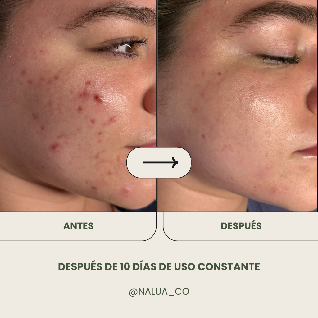 Gel limpiador Anti Acné + Crema humectante Anti Acné