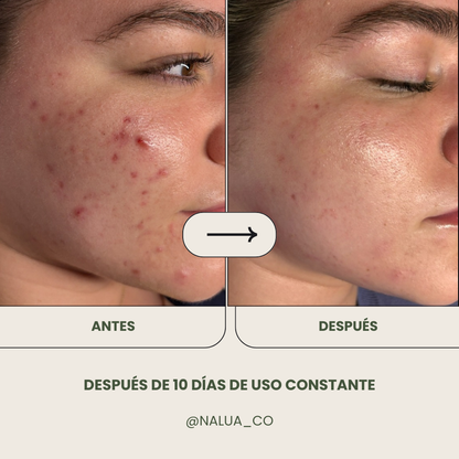 Gel limpiador Anti Acné + Crema humectante Anti Acné