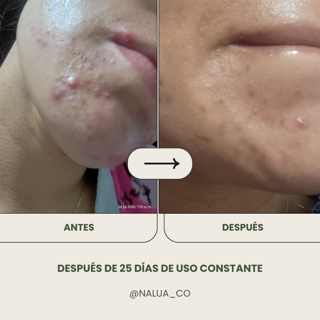 Gel limpiador Anti Acné + Crema humectante Anti Acné