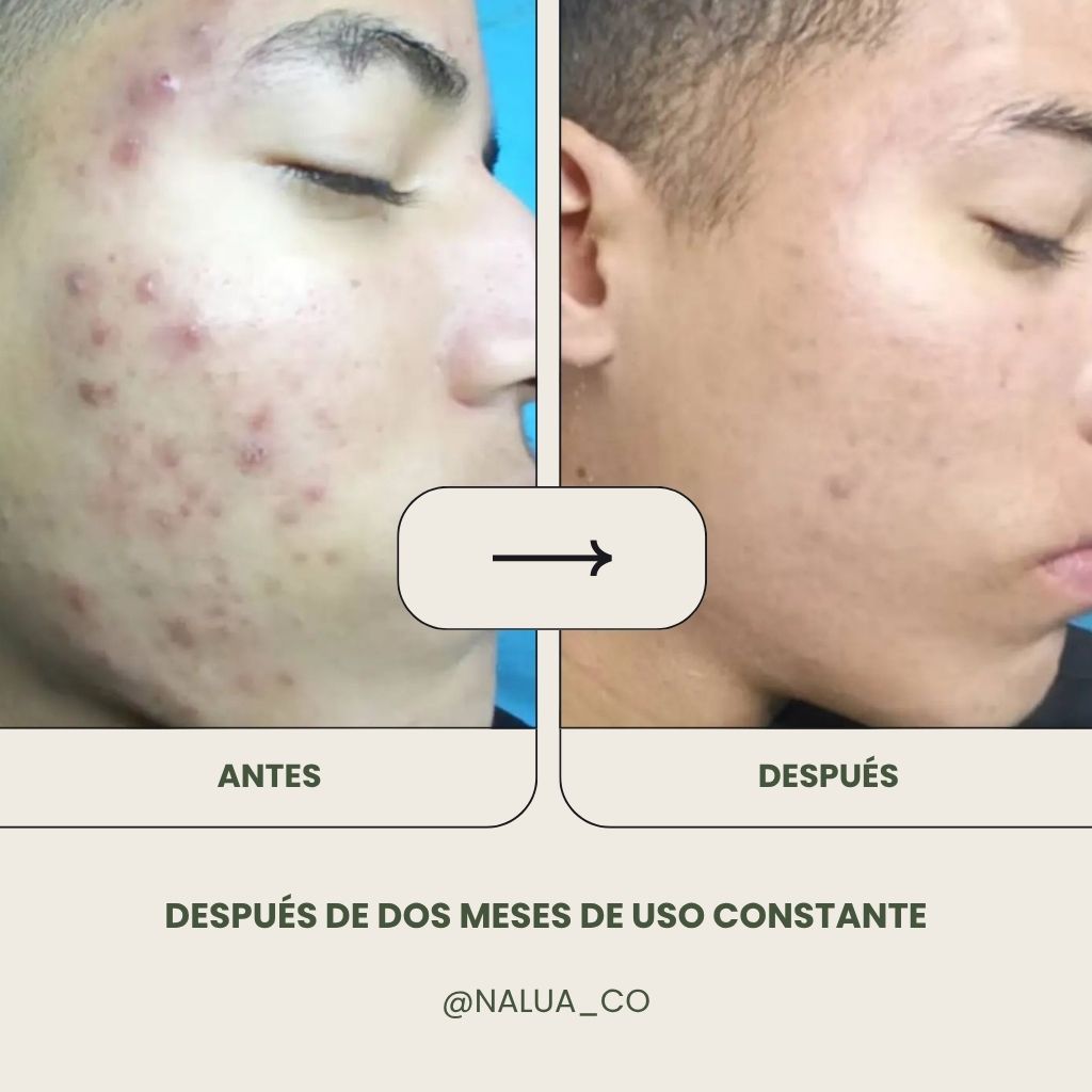 Jabón Liquido Anti Acné