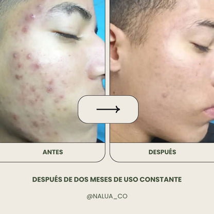 Jabón Liquido Anti Acné