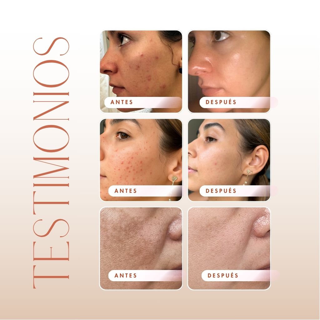 Serum Anti acné + Jabón Liquido