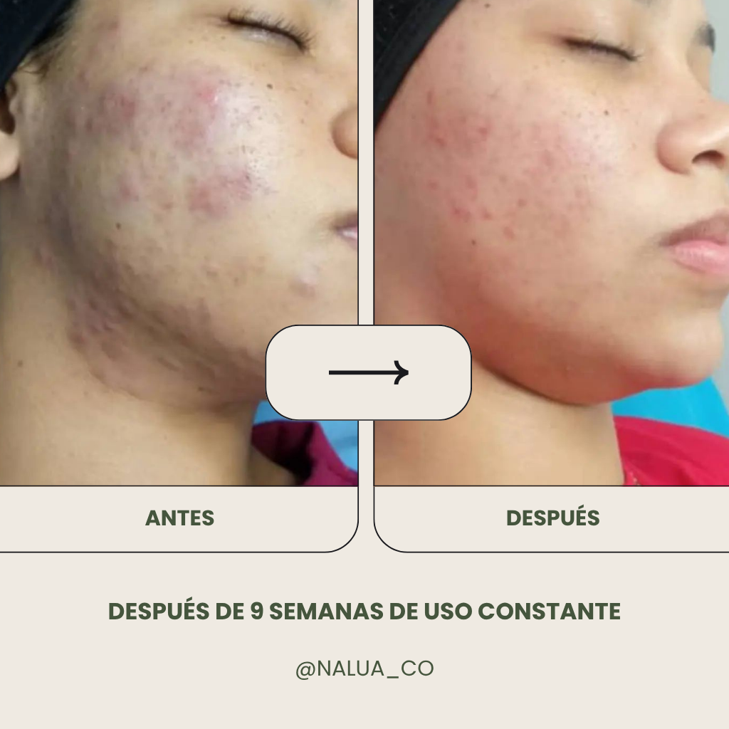 Jabón Liquido Anti Acné