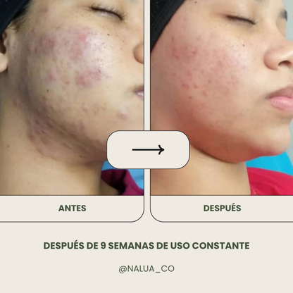 Jabón Liquido Anti Acné