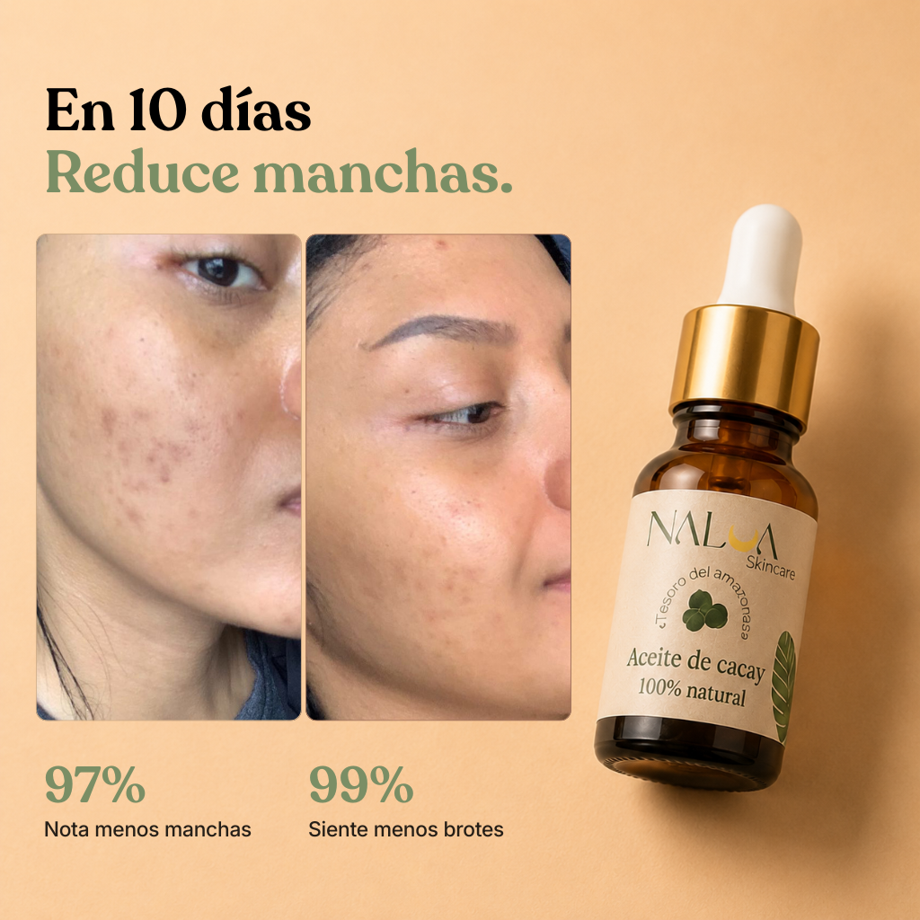 Serum Anti acné y Anti Manchas 2x1 PROMOCIÓN