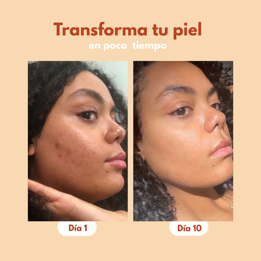 Serum Anti acné y Anti Manchas 2x1