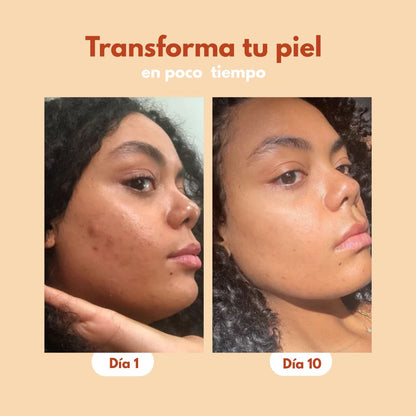 Serum Anti acné y Anti Manchas 2x1