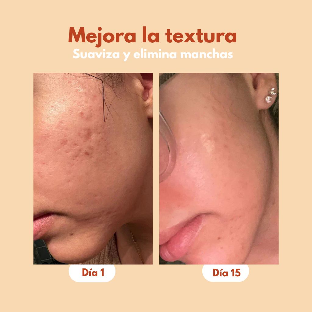 Serum Anti acné y Anti Manchas 2x1